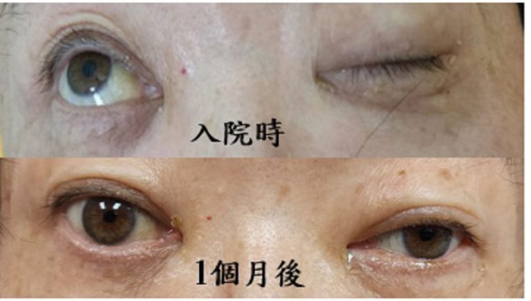 眼睛睜不開 竟是糖尿病惹的禍